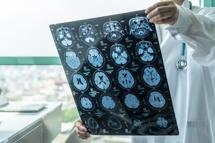 認知障礙症 無記性等於腦退化？醫生提醒及早注意9大警號避免病情惡化